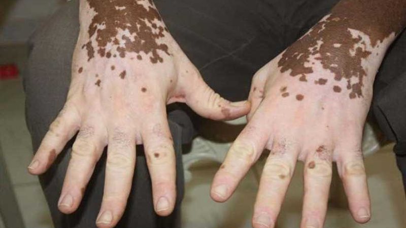 البهاق.. ماذا تعرف