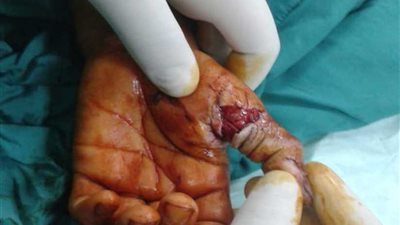 المعاهد التعلمية: تنجح في إعادة توصيل إصبع طفل بعد بتره