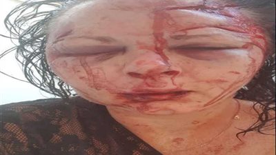تشويه وجه فتاة قاومت شابًا حاول اغتصابها (صور)
