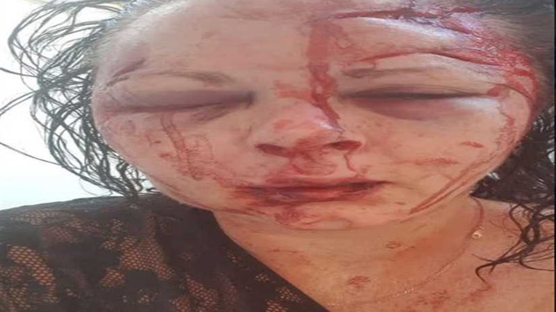 تشويه وجه فتاة قاومت