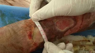 جامعة أسيوط تعالج مريضا يعاني من انسداد في وريد الحوض دام 33 عامًا..(صور)