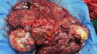 إزالة ورم ١١ كيلو بتأمين صحي المنيا.. صور