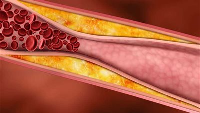 علماء الأحياء.. اكتشاف دواء لتصلب الشرايين