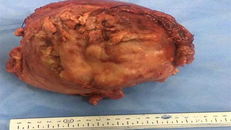 استئصال ورم سرطاني