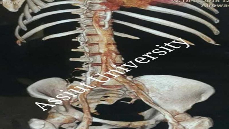 طب أسيوط يجري جراحة