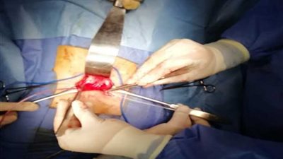 التأمين الصحي ببنها ينجح في إنقاذ طفل من الفشل الكلوي