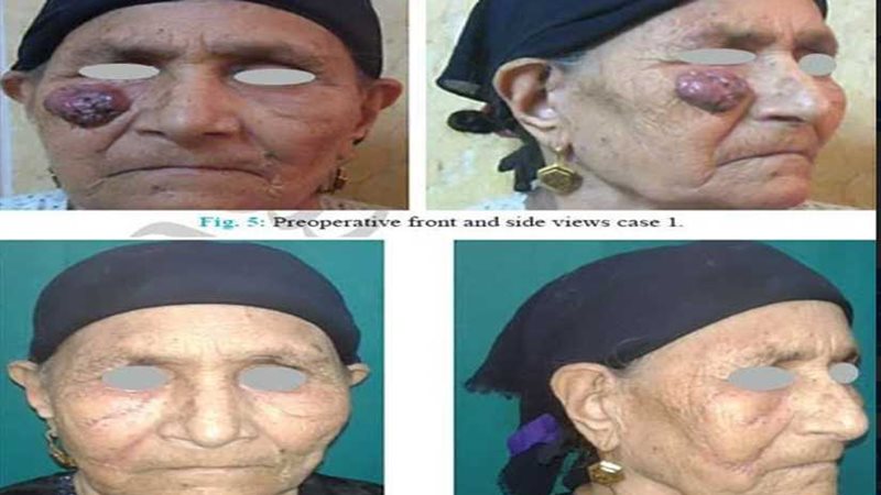 أمل جديد لمرضى أورام