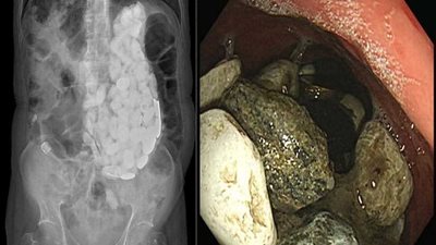 استخراج 2كيلو حجارة وأغطية زجاج وعملات معدنية من معدة مريض (صور)