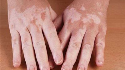 البهاق.. أعراضه وأسبابه وطرق علاجه