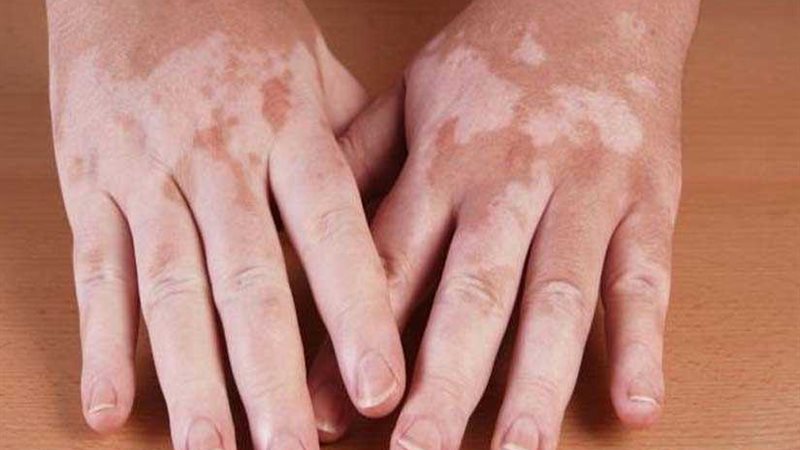 البهاق.. أعراضه وأسبابه