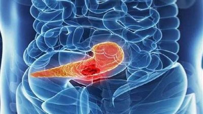 اكتشاف طريقة فعالة لعلاج سرطان البنكرياس