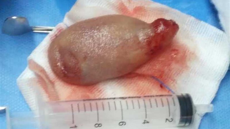 استئصال ورم دموي