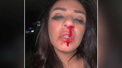 بالصور.. المطربة شاهيناز ضياء تنزف: ضربني وبهدلني أنا وأمي