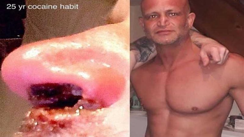 تساقط لحم الأنف لـمضيف