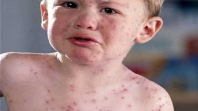 إعلان حالة الطوارئ في نيويورك لمواجهة تفشي الحصبة