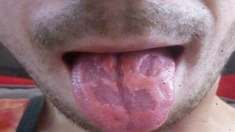 لسان مدرس يتآكل نتيجة