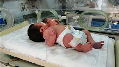 مستشفى الأطفال الجامعي بأسيوط تستقبل طفلا مولودا برأسين