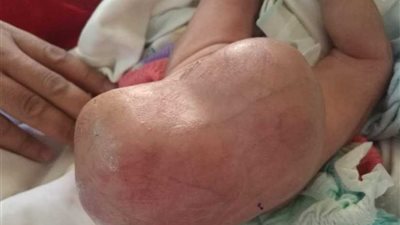 استئصال جزئي لورم نادر لطفلة حديث الولادة بالتأمين الصحي ببنها