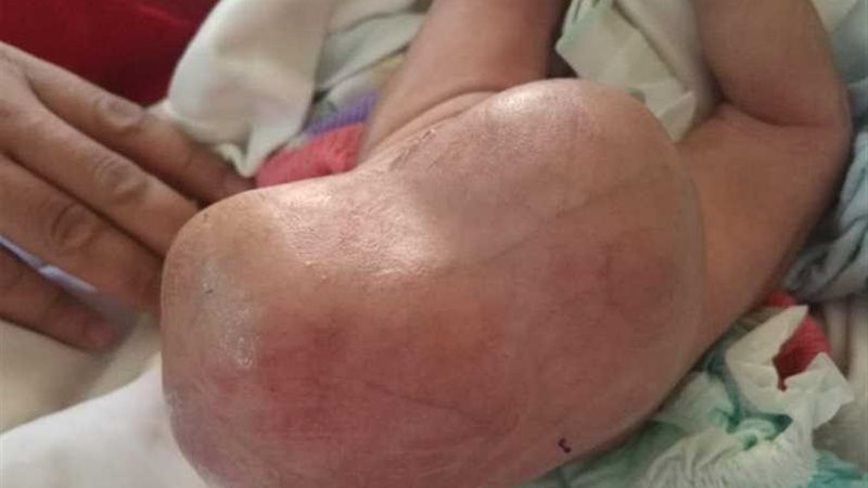 استئصال جزئي لورم