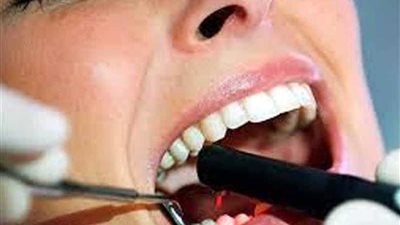 تعرف على حكم خلع الأسنان أثناء الصوم