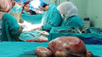 استئصال ورم يزن 20 كيلو من رحم سيدة في جراحة نادرة 
