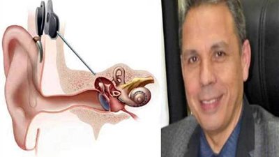 مستشفى مصر للطيران تنجح في زراعة قوقعة لطفل عمره 4 سنوات