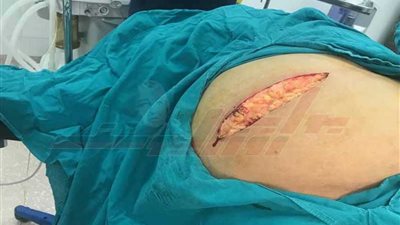 بالصور.. ناصر العام ينجح في إجراء عملية فتق أشبجيلي ضخم لمريضة