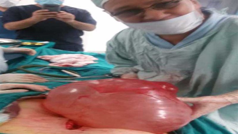 استئصال ورم 7 كيلو