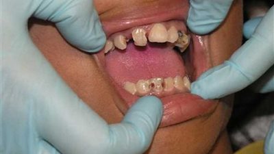 منتشر بكثرة في البلدان العربية.. مشروب يدمر الأسنان