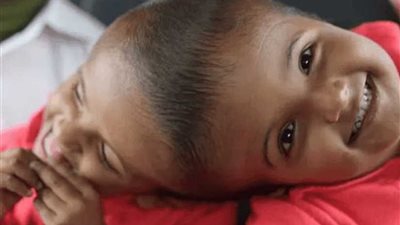 أكثر من 30 جراحا ينجحون في فصل توأم