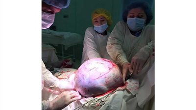 استئصال ورم يزن 25 كيلو جرامًا من رحم مريضة (فيديو وصور)