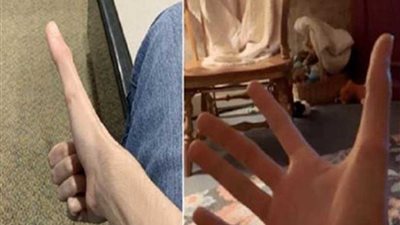 اشتهر بسبب طول إبهامه