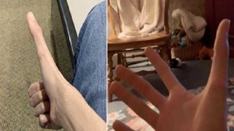 اشتهر بسبب طول إبهامه