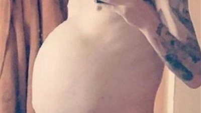 مرض يتسبب في 