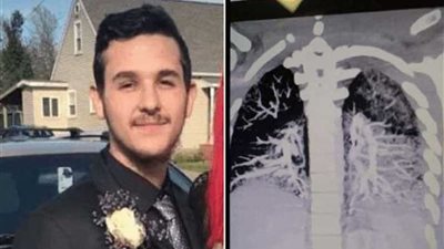 بالأشعة.. شاهد ماذا فعل التدخين في شاب عمره 19عاماً؟