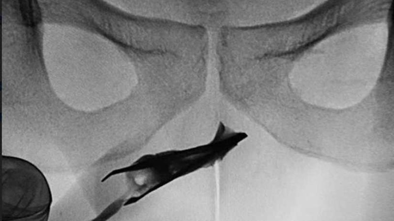 شاب يعيش بملقاط عالق