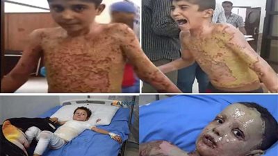بالفيديو والصور.. هجوم كيماوي تركي يحرق عددًا من السوريين
