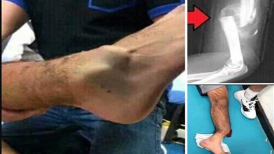 فيديو مروع.. كيف عالج طبيب إيفرتون قدم 