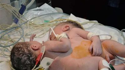 جامعة المنصورة تتكفل برعاية 