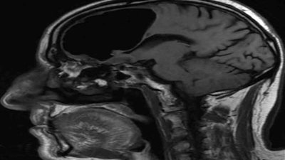 معجزة.. رجل عاش 84 عامًا بتجويف هواء داخل رأسه