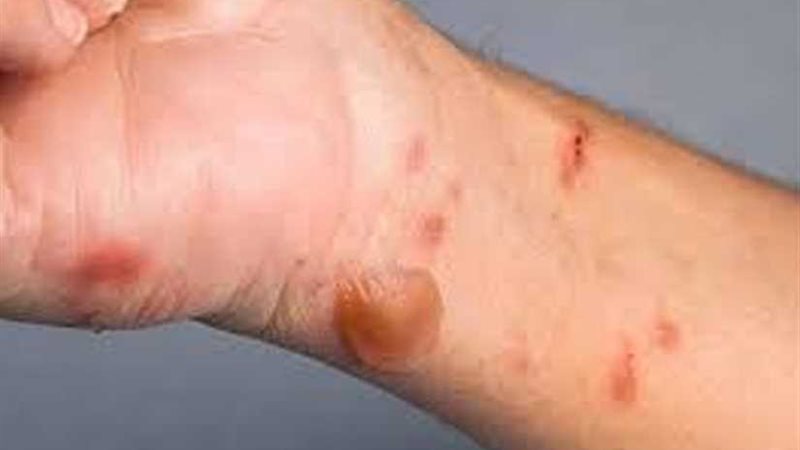 إصابة سيدتين في حريق