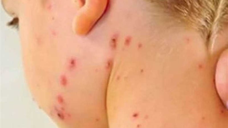 ارتفاع ضحايا وباء