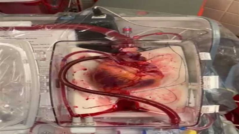 أول عملية زرع قلب
