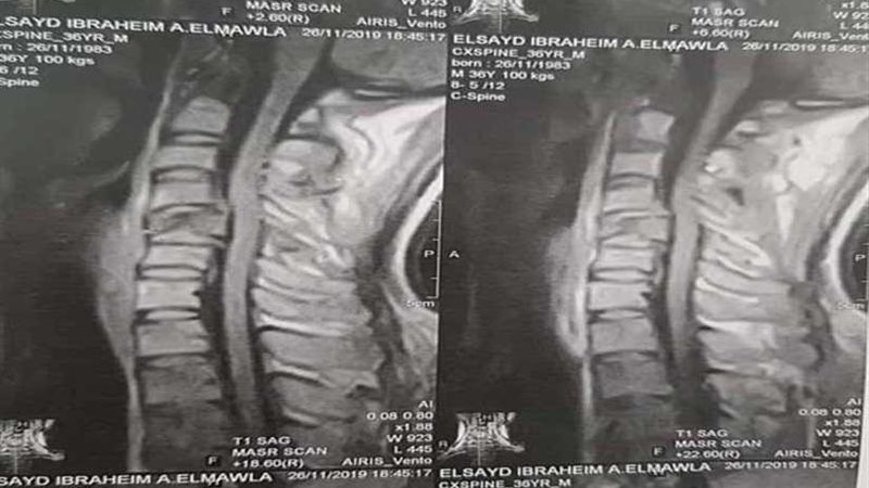 عاجل.. جراحة نادرة