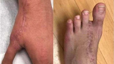 إصبع قدم بدلا من إصبع يد.. مقاطع فيديو للجراحة 