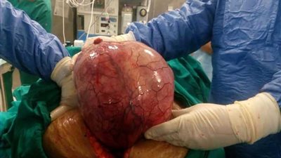 عاجل.. استئصال ورم وزنة تسعة كيلو من سيدة بالقاهرة