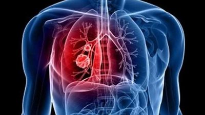 ٣ طرق للوقاية من التهاب الشعب الهوائية..تعرف عليها