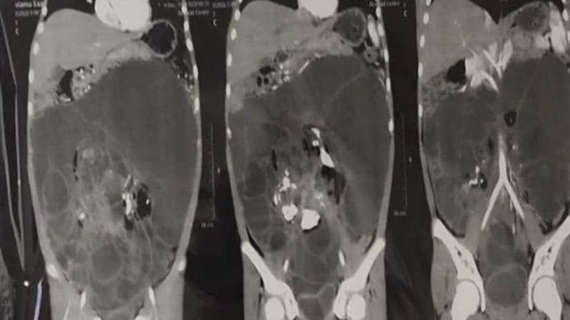 أطباء أسيوط يستأصلون