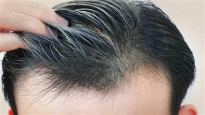 تعرف على توقيت نجاح عملية زراعة الشعر