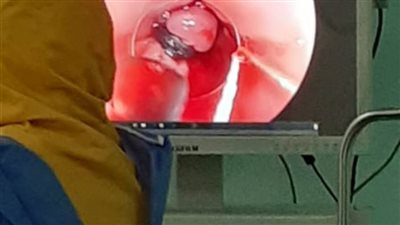 فريق طبي ينجح في إنقاذ مريض 